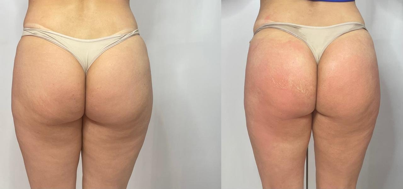 Antes e depois do protocolo Bumbum Up Power no Studio Marli Andrade