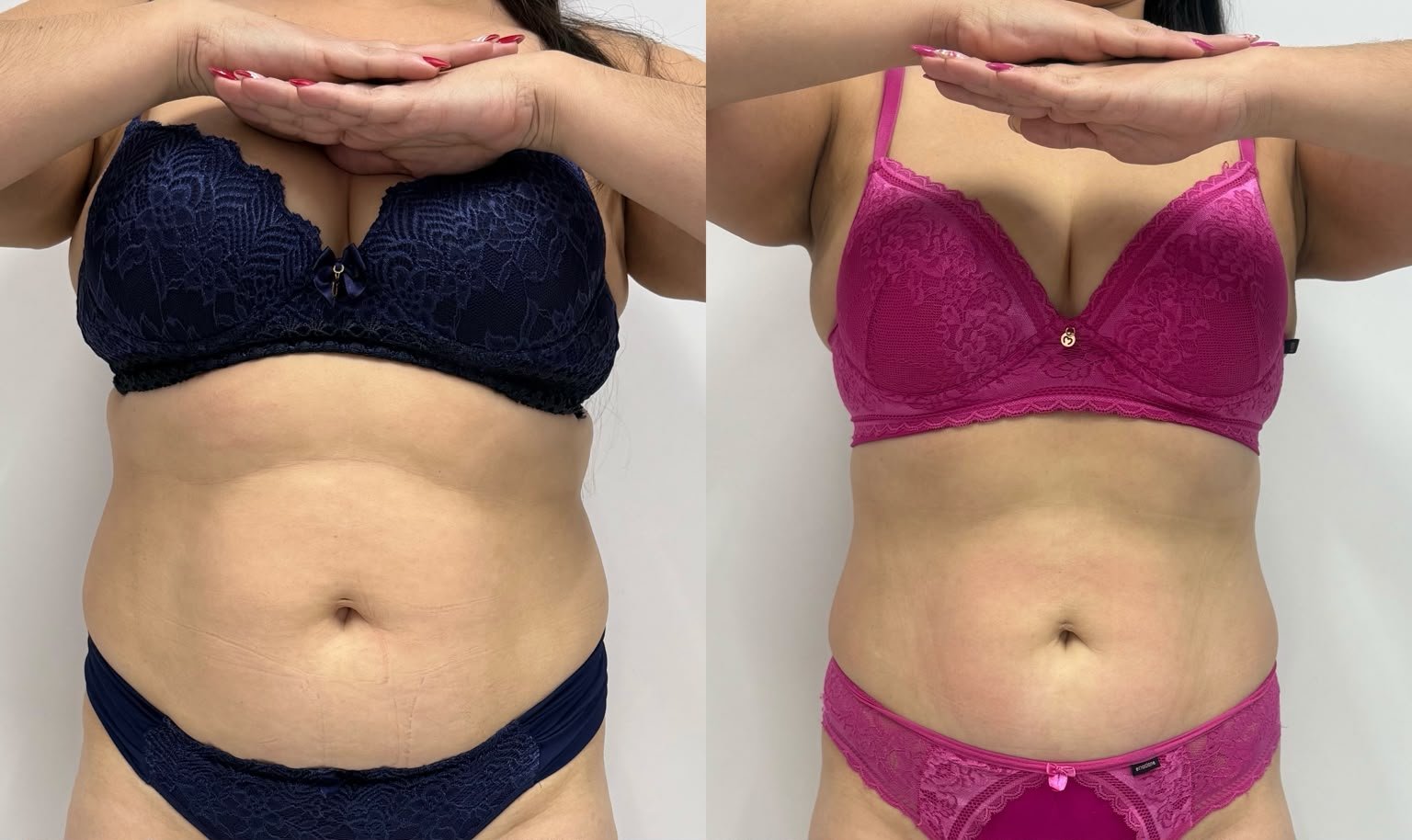 Antes e depois do protocolo Ultracrio no Studio Marli Andrade