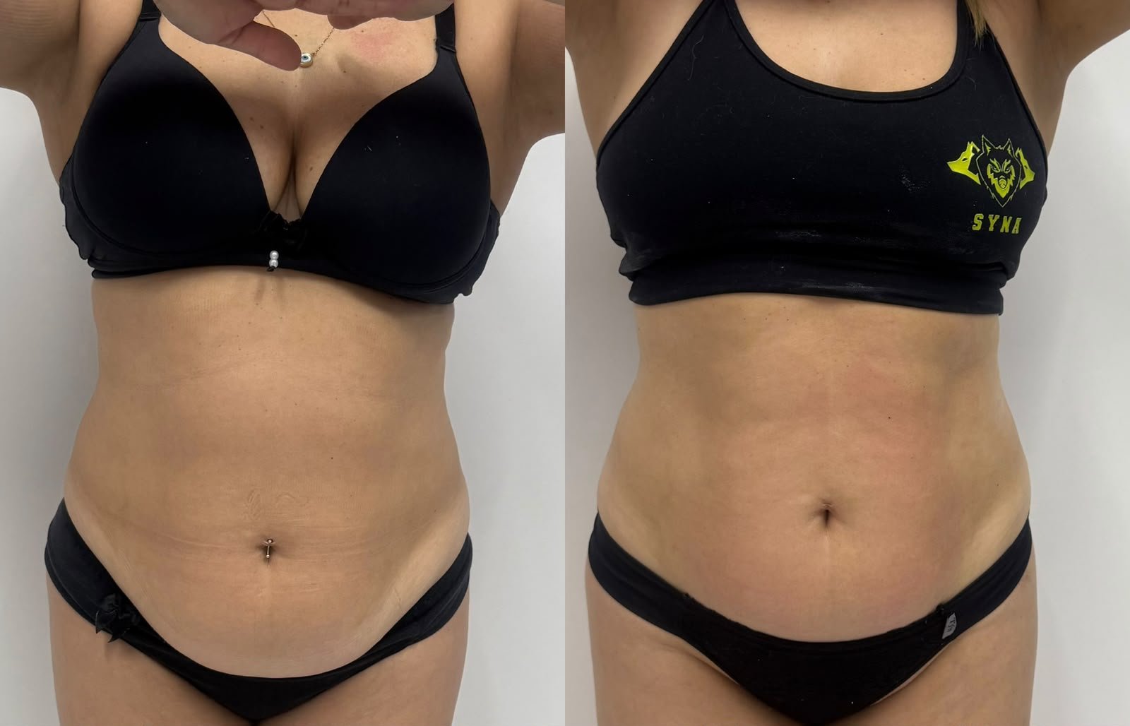 Antes e depois do protocolo Ultralipo Power no Studio Marli Andrade