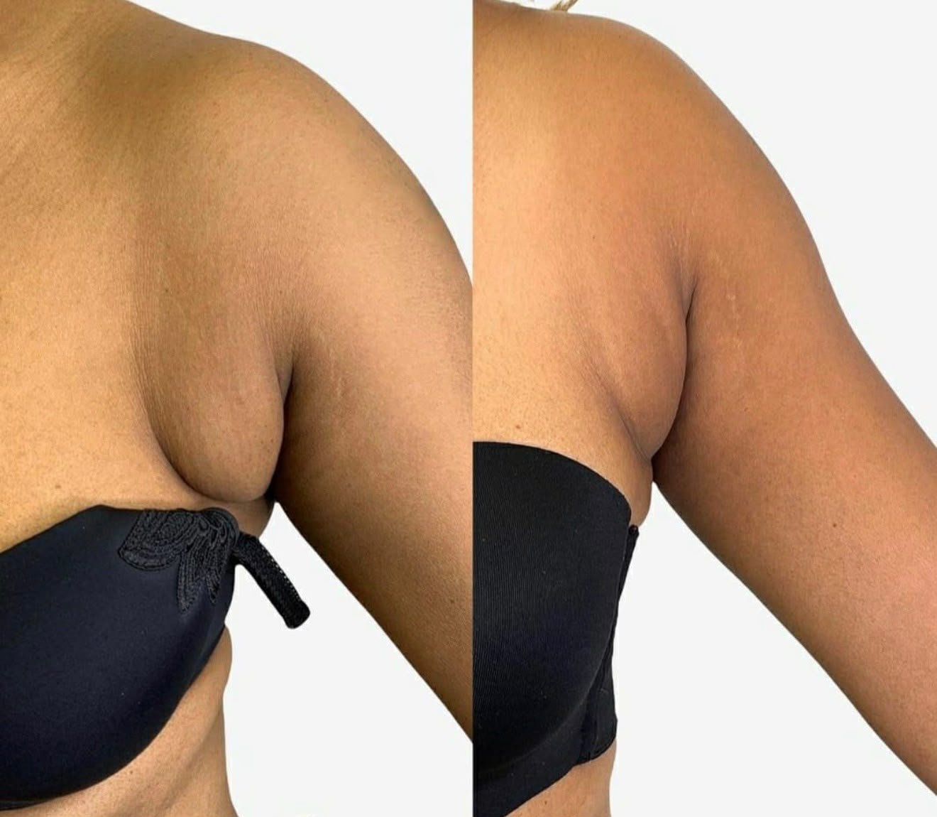 Antes e depois do protocolo Ultramed Corporal no Studio Marli Andrade