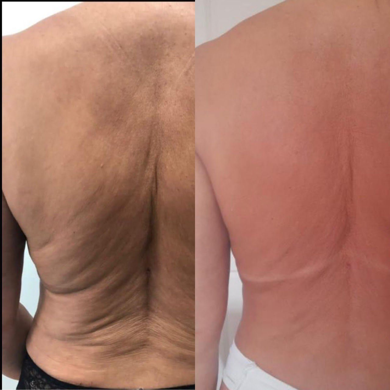 Antes e depois do protocolo Ultramed Corporal para flacidez nas costas, no Studio Marli Andrade