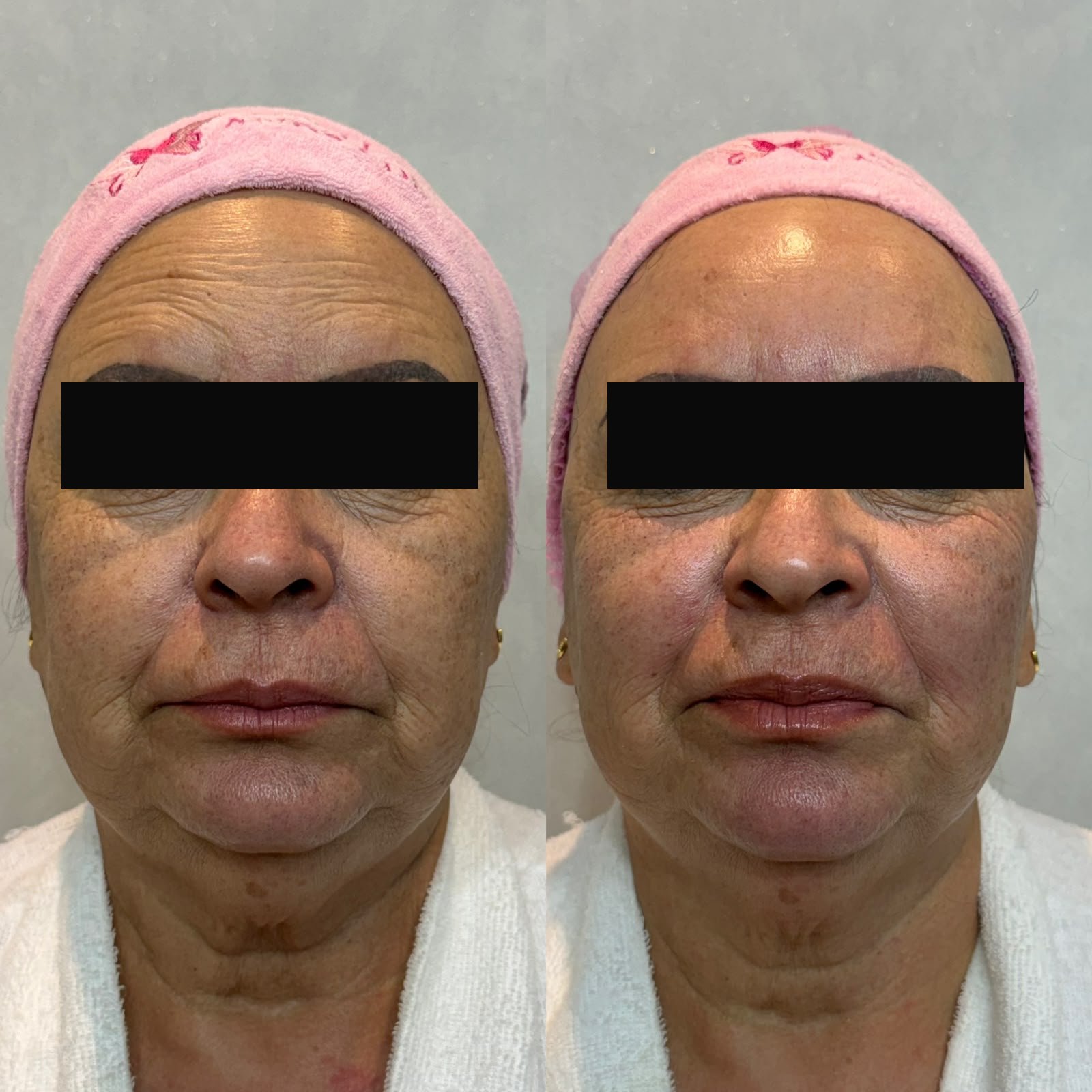 Antes e depois do protocolo Ultramed Facial no Studio Marli Andrade